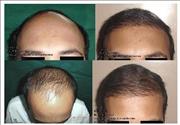 Before After Pictures,Photos ,Delhi,hair transplantation 